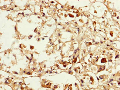 IHC image of MAGEA3 Antibody diluted at 1:200 and staining in paraffin-embedded human melanoma performed on a Leica BondTM system. After dewaxing and hydration, antigen retrieval was mediated by high pressure in a citrate buffer (pH 6.0). Section was blocked with 10% normal goat serum 30min at RT. Then primary antibody (1% BSA) was incubated at 4°C overnight. The primary is detected by a biotinylated secondary antibody and visualized using an HRP conjugated SP system.