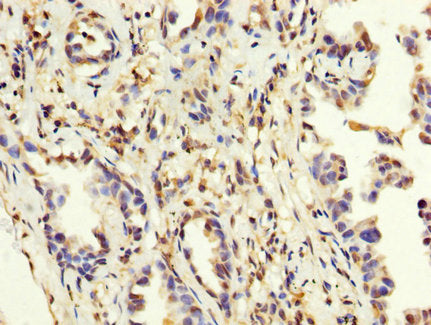 IHC image of MAGEA3 Antibody diluted at 1:200 and staining in paraffin-embedded human lung cancer performed on a Leica BondTM system. After dewaxing and hydration, antigen retrieval was mediated by high pressure in a citrate buffer (pH 6.0). Section was blocked with 10% normal goat serum 30min at RT. Then primary antibody (1% BSA) was incubated at 4°C overnight. The primary is detected by a biotinylated secondary antibody and visualized using an HRP conjugated SP system.