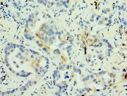 Immunohistochemistry of paraffin-embedded human lung cancer using MAGEA6 Antibody at dilution of 1:100
