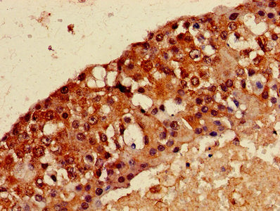 Immunohistochemistry of paraffin-embedded human breast cancer using the antibody at dilution of 1:100