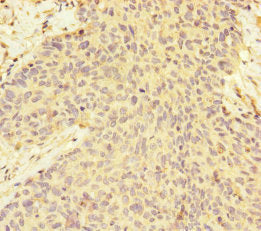 Immunohistochemistry of paraffin-embedded human ovarian cancer using MAGOH Antibody at dilution of 1:100