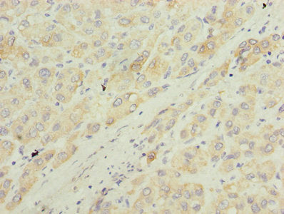 Immunohistochemistry of paraffin-embedded human liver cancer using MAOA Antibody at dilution of 1:100