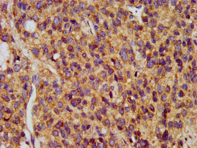 IHC image of MAP1A Antibody diluted at 1:400 and staining in paraffin-embedded human glioma performed on a Leica BondTM system. After dewaxing and hydration, antigen retrieval was mediated by high pressure in a citrate buffer (pH 6.0). Section was blocked with 10% normal goat serum 30min at RT. Then primary antibody (1% BSA) was incubated at 4°C overnight. The primary is detected by a biotinylated secondary antibody and visualized using an HRP conjugated SP system.