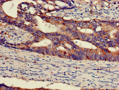 IHC image of MAP2K1 Antibody diluted at 1:300 and staining in paraffin-embedded human colon cancer performed on a Leica BondTM system. After dewaxing and hydration, antigen retrieval was mediated by high pressure in a citrate buffer (pH 6.0). Section was blocked with 10% normal goat serum 30min at RT. Then primary antibody (1% BSA) was incubated at 4°C overnight. The primary is detected by a biotinylated secondary antibody and visualized using an HRP conjugated SP system.
