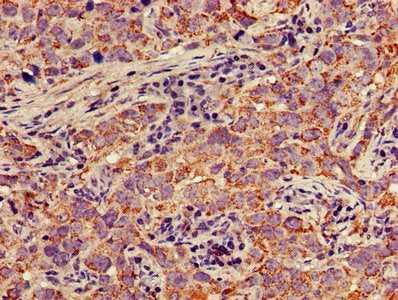 IHC image of MAP2K1 Antibody diluted at 1:300 and staining in paraffin-embedded human pancreatic cancer performed on a Leica BondTM system. After dewaxing and hydration, antigen retrieval was mediated by high pressure in a citrate buffer (pH 6.0). Section was blocked with 10% normal goat serum 30min at RT. Then primary antibody (1% BSA) was incubated at 4°C overnight. The primary is detected by a biotinylated secondary antibody and visualized using an HRP conjugated SP system.
