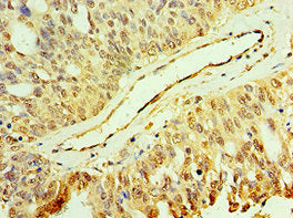 Immunohistochemistry of paraffin-embedded human endometrial cancer using the antibody at dilution of 1:100