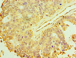 Immunohistochemistry of paraffin-embedded human endometrial cancer using MAP2K3 Antibody at dilution of 1:100