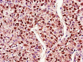 Immunohistochemistry of paraffin-embedded human liver cancer using MAP2K4 Antibody at dilution of 1:100