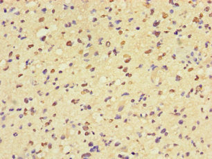 Immunohistochemistry of paraffin-embedded human glioma using MAP3K8 Antibody at dilution of 1:100