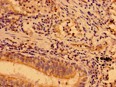 IHC image of MAP3K9 Antibody diluted at 1:400 and staining in paraffin-embedded human lung cancer performed on a Leica BondTM system. After dewaxing and hydration, antigen retrieval was mediated by high pressure in a citrate buffer (pH 6.0). Section was blocked with 10% normal goat serum 30min at RT. Then primary antibody (1% BSA) was incubated at 4°C overnight. The primary is detected by a biotinylated secondary antibody and visualized using an HRP conjugated SP system.
