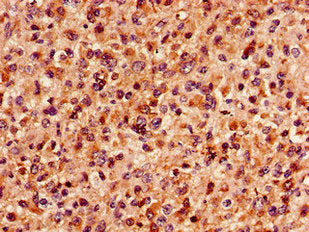 Immunohistochemistry of paraffin-embedded human glioma using the antibody at dilution of 1:100