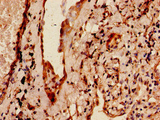 Immunohistochemistry of paraffin-embedded human lung cancer using MAP4 Antibody at dilution of 1:100