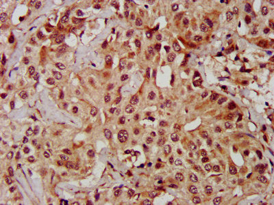IHC image of MAPK1 Antibody diluted at 1:600 and staining in paraffin-embedded human liver cancer performed on a Leica BondTM system. After dewaxing and hydration, antigen retrieval was mediated by high pressure in a citrate buffer (pH 6.0). Section was blocked with 10% normal goat serum 30min at RT. Then primary antibody (1% BSA) was incubated at 4°C overnight. The primary is detected by a biotinylated secondary antibody and visualized using an HRP conjugated SP system.