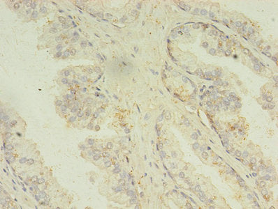 Immunohistochemistry of paraffin-embedded human prostate cancer using MAPK13 Antibody at dilution of 1:100