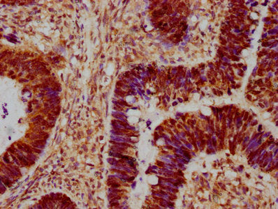 IHC image of MAPK14 Antibody diluted at 1:300 and staining in paraffin-embedded human ovarian cancer performed on a Leica BondTM system. After dewaxing and hydration, antigen retrieval was mediated by high pressure in a citrate buffer (pH 6.0). Section was blocked with 10% normal goat serum 30min at RT. Then primary antibody (1% BSA) was incubated at 4°C overnight. The primary is detected by a biotinylated secondary antibody and visualized using an HRP conjugated SP system.