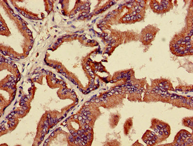 IHC image of MAPK3 Antibody diluted at 1:600 and staining in paraffin-embedded human prostate cancer performed on a Leica BondTM system. After dewaxing and hydration, antigen retrieval was mediated by high pressure in a citrate buffer (pH 6.0). Section was blocked with 10% normal goat serum 30min at RT. Then primary antibody (1% BSA) was incubated at 4°C overnight. The primary is detected by a biotinylated secondary antibody and visualized using an HRP conjugated SP system.