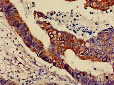 IHC image of MAPK3 Antibody diluted at 1:600 and staining in paraffin-embedded human colon cancer performed on a Leica BondTM system. After dewaxing and hydration, antigen retrieval was mediated by high pressure in a citrate buffer (pH 6.0). Section was blocked with 10% normal goat serum 30min at RT. Then primary antibody (1% BSA) was incubated at 4°C overnight. The primary is detected by a biotinylated secondary antibody and visualized using an HRP conjugated SP system.