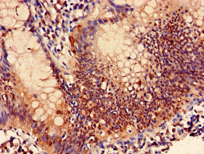 Immunohistochemistry of paraffin-embedded human colon cancer using PSMB7 Antibody at dilution of 1:100Rabbit anti-Human PSMB7 Polyclonal Antibody