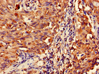 Immunohistochemistry of paraffin-embedded human lung cancer using MAS1L Antibody at dilution of 1:100