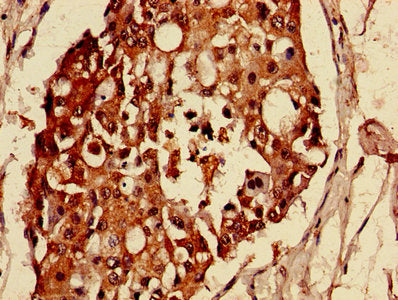 Immunohistochemistry of paraffin-embedded human breast cancer using MAS1L Antibody at dilution of 1:100