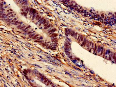 Immunohistochemistry of paraffin-embedded human colon cancer using MAT2A Antibody at dilution of 1:100