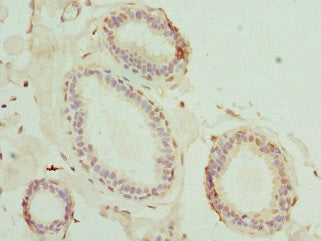 Immunohistochemistry of paraffin-embedded human breast cancer using MATK Antibody at dilution of 1:100