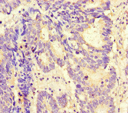 Immunohistochemistry of paraffin-embedded human colon cancer using MAX Antibody at dilution of 1:100