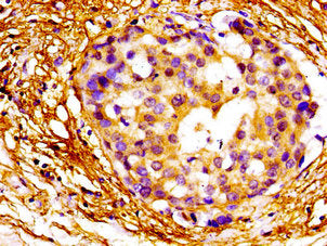 Immunohistochemistry of paraffin-embedded human breast cancer using MAZ Antibody at dilution of 1:100
