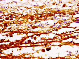 Immunohistochemistry of paraffin-embedded human melanoma using MAZ Antibody at dilution of 1:100