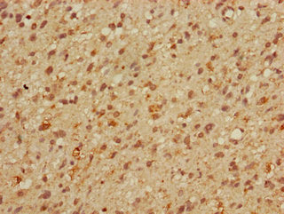 Immunohistochemistry of paraffin-embedded human glioma using MBD3 Antibody at dilution of 1:100