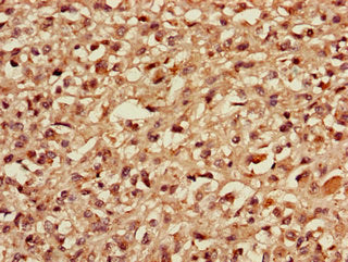 Immunohistochemistry of paraffin-embedded human melanoma using MBD3 Antibody at dilution of 1:100