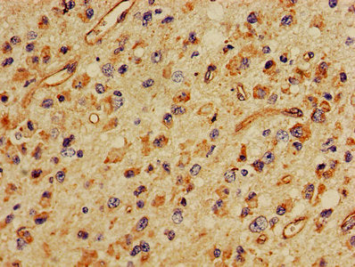 IHC image of MBP Antibody diluted at 1:400 and staining in paraffin-embedded human glioma performed on a Leica BondTM system. After dewaxing and hydration, antigen retrieval was mediated by high pressure in a citrate buffer (pH 6.0). Section was blocked with 10% normal goat serum 30min at RT. Then primary antibody (1% BSA) was incubated at 4°C overnight. The primary is detected by a biotinylated secondary antibody and visualized using an HRP conjugated SP system.