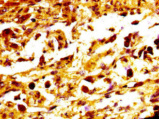 IHC image of MC1R Antibody diluted at 1:400 and staining in paraffin-embedded human melanoma performed on a Leica BondTM system. After dewaxing and hydration, antigen retrieval was mediated by high pressure in a citrate buffer (pH 6.0). Section was blocked with 10% normal goat serum 30min at RT. Then primary antibody (1% BSA) was incubated at 4°C overnight. The primary is detected by a biotinylated secondary antibody and visualized using an HRP conjugated SP system.