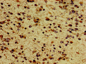 Immunohistochemistry of paraffin-embedded human glioma using the antibody at dilution of 1:100