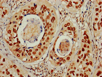 IHC image of MCM2 Antibody diluted at 1:600 and staining in paraffin-embedded human cervical cancer performed on a Leica BondTM system. After dewaxing and hydration, antigen retrieval was mediated by high pressure in a citrate buffer (pH 6.0). Section was blocked with 10% normal goat serum 30min at RT. Then primary antibody (1% BSA) was incubated at 4°C overnight. The primary is detected by a biotinylated secondary antibody and visualized using an HRP conjugated SP system.