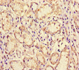 Immunohistochemistry of paraffin-embedded human gastric cancer using ME1 Antibody at dilution of 1:100