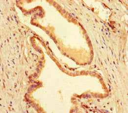 Immunohistochemistry of paraffin-embedded human prostate cancer using MEIS1 Antibody at dilution of 1:100