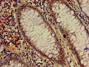 Immunohistochemistry of paraffin-embedded human colon cancer using the antibody at dilution of 1:100