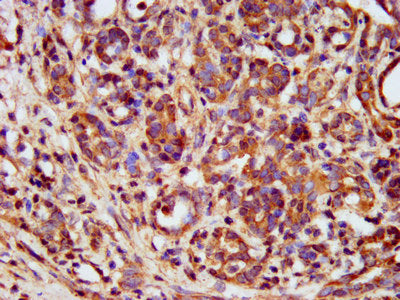 IHC image of METAP1 Antibody diluted at 1:400 and staining in paraffin-embedded human pancreatic cancer performed on a Leica BondTM system. After dewaxing and hydration, antigen retrieval was mediated by high pressure in a citrate buffer (pH 6.0). Section was blocked with 10% normal goat serum 30min at RT. Then primary antibody (1% BSA) was incubated at 4°C overnight. The primary is detected by a biotinylated secondary antibody and visualized using an HRP conjugated SP system.