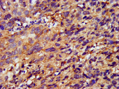 IHC image of METAP1 Antibody diluted at 1:400 and staining in paraffin-embedded human ovarian cancer performed on a Leica BondTM system. After dewaxing and hydration, antigen retrieval was mediated by high pressure in a citrate buffer (pH 6.0). Section was blocked with 10% normal goat serum 30min at RT. Then primary antibody (1% BSA) was incubated at 4°C overnight. The primary is detected by a biotinylated secondary antibody and visualized using an HRP conjugated SP system.