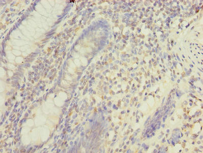 Immunohistochemistry of paraffin-embedded human colon cancer using the antibody at dilution of 1:100