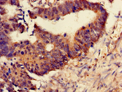 Immunohistochemistry of paraffin-embedded human colon cancer using PSMB4 Antibody at dilution of 1:100Rabbit anti-Human PSMB4 Polyclonal Antibody