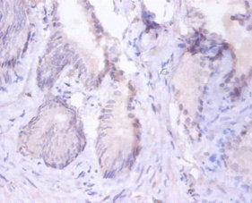 Immunohistochemistry of paraffin-embedded human prostate tissue using PSMB4 Antibody at dilution of 1:100Rabbit anti-Human PSMB4 Polyclonal Antibody