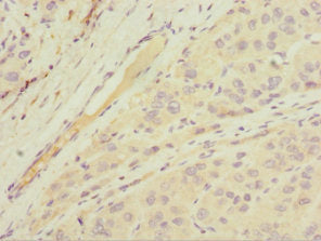 Immunohistochemistry of paraffin-embedded human liver cancer using MGAT1 Antibody at dilution of 1:100