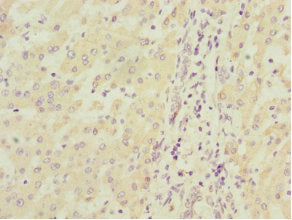 Immunohistochemistry of paraffin-embedded human liver cancer using MGLL Antibody at dilution of 1:100