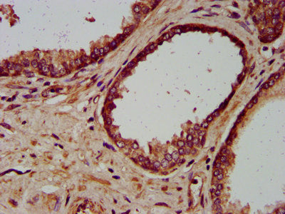 IHC image of the antibody diluted at 1:200 and staining in paraffin-embedded human prostate cancer performed on a Leica BondTM system. After dewaxing and hydration, antigen retrieval was mediated by high pressure in a citrate buffer (pH 6.0). Section was blocked with 10% normal goat serum 30min at RT. Then primary antibody (1% BSA) was incubated at 4°C overnight. The primary is detected by a biotinylated secondary antibody and visualized using an HRP conjugated SP system.