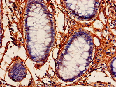Immunohistochemistry of paraffin-embedded human colon cancer using the antibody at dilution of 1:100Rabbit anti-Human PFDN5 Polyclonal Antibody