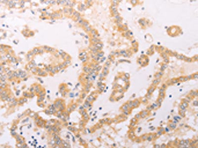 The image on the left is immunohistochemistry of paraffin-embedded Human thyroid cancer tissue using F7 Antibody(F7 Antibody) at dilution 1/40, on the right is treated with fusion protein. (Original magnification: ×200)