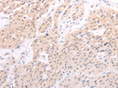The image on the left is immunohistochemistry of paraffin-embedded Human lung cancer tissue using the antibody Antibody) at dilution 1/40, on the right is treated with fusion protein. (Original magnification: ×200)