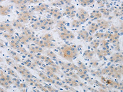 The image on the left is immunohistochemistry of paraffin-embedded Human liver cancer tissue using CKMT1A Antibody(CKMT1A/CKMT1B Antibody) at dilution 1/80, on the right is treated with synthetic peptide. (Original magnification: ×200)Rabbit anti-Human CKMT1A Polyclonal Antibody